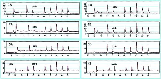 Figure 4. Relative quantification of normal versus mutant alleles. Pyrograms showing the percentage of wild-type allele (first C-peak) in cDNA (1A-4A) and DNA (1B-4B) of 3 patients (1-3) and a control individual (4).