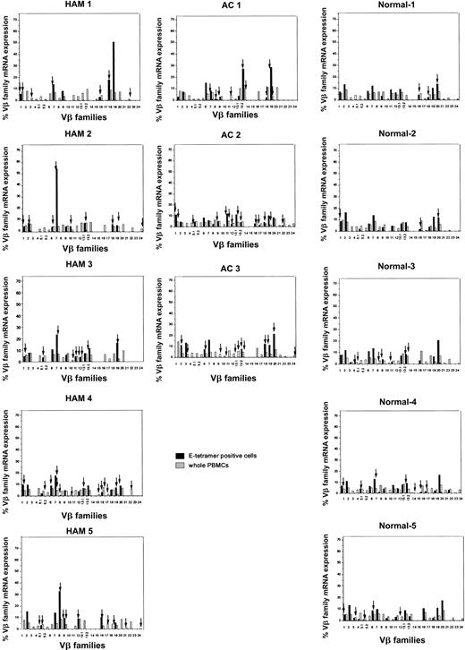 Figure 4. Expression of TCR Vβ transcripts in HLA-E tetramer–positive cells and PBMCs from HTLV-1–infected individuals and seronegative controls, analyzed by RT-PCR. The relative amounts of Vβ transcripts in whole PBMCs (hatched bars) and HLA-E tetramer–positive cells (black bars) were quantified by fluorescence with Genescan software. Arrows indicate monoclonal or oligoclonal spectratype bands (see “Patients, materials, and methods” for definition of oligoclonality).