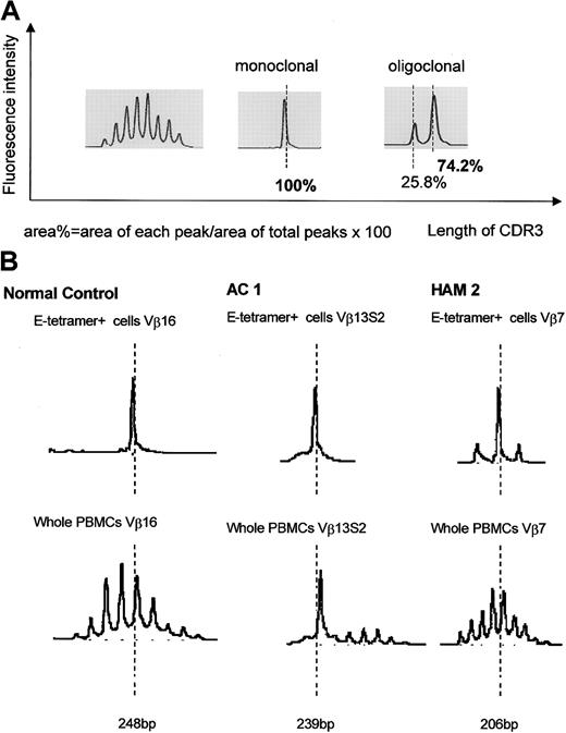 Figure 5. CDR3 length profiles for TCR transcripts in CD8+ HLA-E tetramer–positive T cells from HTLV-1–infected individuals and seronegative controls. (A) Left portion shows typical gaussian profiles found in spectratypes derived from total PBMCs. Each Vβ spectratype generally had 5 to 7 peaks with 1 or 2 dense bands in their middle portion. Center and right portions show “monoclonal” and “oligoclonal” spectratypes observed in some HLA-E tetramer–positive cells. (B) Representative results of TCR spectratyping from HAM/TSP patients, asymptomatic carriers, and healthy controls.