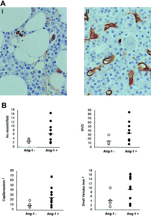 Figure 6. BM angiogenesis in patients with MM. Blood vessels were detected in 3-μm sections of 4% formalin and B5 solution-fixed, paraffin-embedded specimens obtained from patients with MM. Angiogenesis was measured as number of vessels per 400 × field and density of microvessels (capillaries and small venules) by staining endothelial cells using anti-CD34 monoclonal antibody, as described in “Materials and methods.” (A) BM angiogenesis in 2 representative patients: Ang-1–negative patient (i) and Ang-1–positive patient (ii) with MM. Original magnification, × 400. (B) Plots represent individual values, and bars represent mean levels.