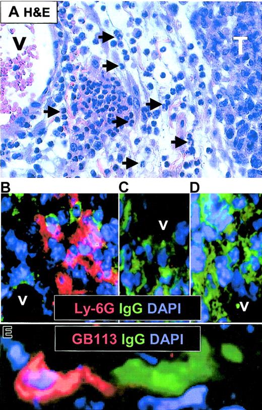 Figure 6. Histologic analysis of inflamed F9 tumors after injection of Id-specific T cells. SCID mice with barely palpable subcutaneous F9 or F55 tumors were injected intravenously with purified Id-specific CD4+ T cells (1 × 106) and analyzed 4 to 5 days later. (A) Hematoxylin and eosin–stained section of paraffin-embedded acutely inflamed F9 (15 mm diameter) tumor. V indicates vessel; and T, tumor. Arrows mark some of the neutrophils infiltrating the perivascular edematous connective tissue. (B-C) Immunohistochemistry on cryosections of tumor tissue. Ly-6G (Gr-1) is shown in red, IgG in green, and nuclei (DAPI) in blue. Lymphoma cells express surface IgG2a and are therefore stained green. (B) F9 tumor in mice injected with T cells. (C) F9 tumor in mice not injected with T cells. (D) F55 tumor in mice injected with T cells. (E) Same tumor as in panel B, but stained for detection of Id-specific T cells (GB113, clonotype-specific, red) and IgG+ F9 cells. Original magnification, × 60.