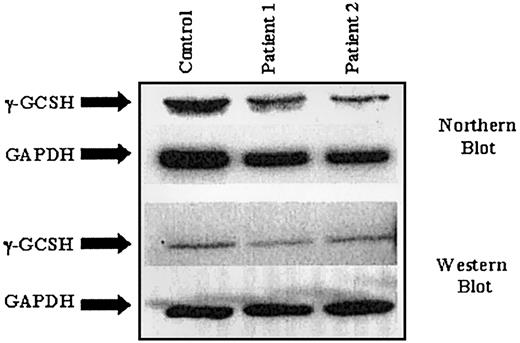 Figure 1. Northern and Western blot analysis on samples from 2 patients with γ-GCSH deficiency.