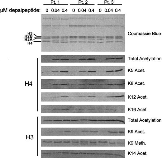 Figure 1. Depsipeptide induction of lysine-specific changes in histone acetylation. The amount of global and lysine-specific acetylated H3 and H4 in CLL cells increases in a dose-dependent manner following a 4-hour incubation with depsipeptide. Patients' mononuclear cells were isolated and cultured in media or depsipeptide (0.04 and 0.4 μM) for 4 hours. Histone extractions were performed at 4 hours and analyzed by SDS-PAGE/immunoblotting with antihuman antibodies for acetylated H3 and H4 and specific lysine residues on these histones. Equivalent loading was verified by staining with Coomassie blue.