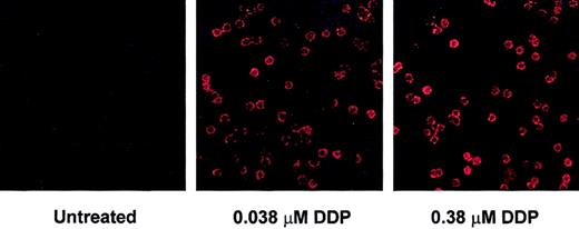Figure 2. Depsipeptide induction of histone H3 acetylation in CLL cells. Histone H3 acetylation increases in the majority of CLL cells following treatment with depsipeptide. CLL cells were incubated in media or depsipeptide (0.038 and 0.38 μM) for 4 hours. Acetylation of H3 was analyzed at 4 hours by immunofluorescence detection with Cy3-conjugated antiacetylated H3 and appropriate negative control antibodies. Magnification is × 100 in all panels.