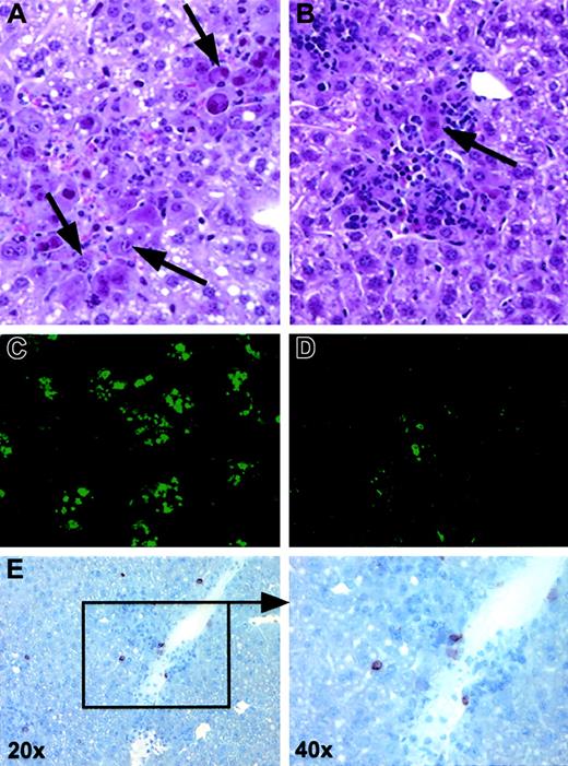 Figure 8. Liver histopathology after MCMV infection. (A) Severe MCMV hepatitis day 20 following LT-HSC transplantation (original magnification × 40). (B) Lymphocytic infiltration day 20 following CLP cotransplantation (original magnification × 40). Panels A and B are stained with H&E. Arrows indicate cytomegalic hepatocytes with viral inclusions. (C-D) Immunofluorescent localization of lacZ-tagged MCMV RM427+ (green; original magnification × 10) in mice that received LT-HSCs (C) and CLP cotransplants (D). (E) Immunohistochemical detection of CD45.1+ CLP-derived cells in the liver (brown, counterstained with hematoxylin).