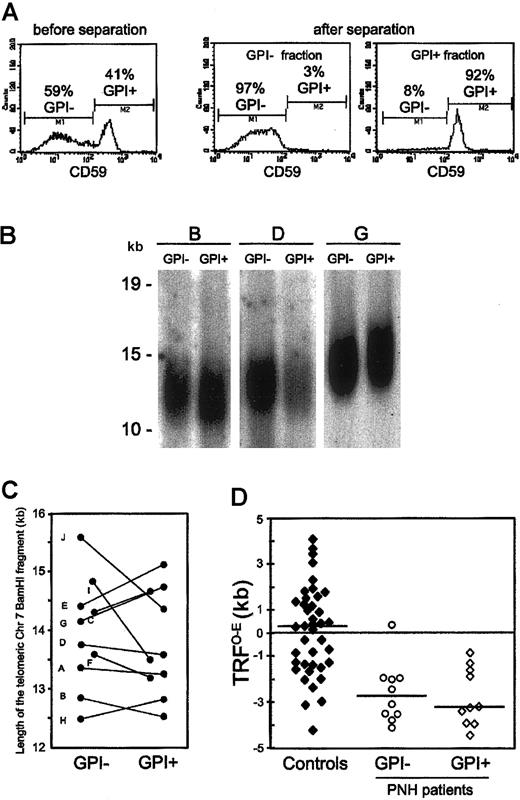 Figure 1. Telomere dynamics of GPI– and GPI+ granulocytes from patients with PNH. (A) Immunomagnetic separation of GPI– and GPI+ granulocytes from a patient with PNH (left panel). By staining with anti-CD59, one sees the efficient separation of GPI– (middle panel) and GPI+ (right panel) granulocytes. This technique enabled us to recover both the GPI– and the GPI+ granulocytes with a purity higher than 90%, as assessed by flow cytometry after staining with anti-CD59. (B) Southern blot analysis of the telomere length of GPI– and GPI+ granulocytes from 3 patients with PNH. Each patient is indicated by a capital letter (Table 1). Ten micrograms of high molecular weight genomic DNA, digested to completion with BamHI, was resolved on 1% agarose gel by field-inversion gel electrophoresis. After blotting, the filter was hybridized with TelBam8, a probe that is unique for the subtelomeric region of the long arm of chromosome 7.23 The length of the BamHI telomeric fragment was calculated from the densitometric profile. We have previously shown that by this method, in a side-by-side comparison, differences greater than 320 bp are significant.20 (C) Telomere length in GPI+ and in GPI– granulocytes from individual patients. The differences in telomere length between paired DNA samples of GPI– and GPI+ granulocytes from each PNH patient are shown by individual straight lines. Each patient is indicated by a capital letter (Table 1). (D) Scattergrams of the TRFO–E (difference between the observed telomere length, TRFO, and the expected-for-age telomere length, TRFE) in GPI– and GPI+ granulocytes from PNH patients, and in 40 age-matched healthy individuals (controls). The horizontal lines across each set of data points are the median values.