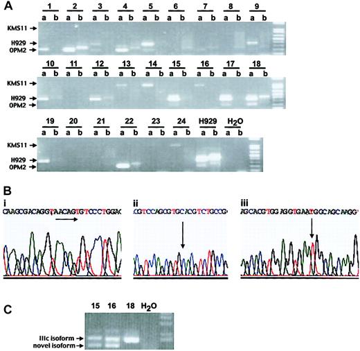 Figure 1. FGFR3 gene translocation and mutation screening in MM patients. (A) Detection of immunoglobulin heavy chain (IgH)/MMSET fusion product using translocation-specific RT-PCR5 (a lanes represent MMSET + JH PCR, whereas b lanes represent MMSET + 1 m PCR). Of 24 patient samples, 22 are positive: 5 patients have a translocation breakpoint as in the myeloma cell line KMS11, 9 patients have a breakpoint like H929, and 8 patients have an OPM2 breakpoint. (B) Genetic changes of FGFR3 gene in patient samples. (i) Sequence analysis of cloned cDNA of patient no. 1 revealed a 6-bp insertion of 5′-AACAGT-3′ at nucleotide position 1306, resulting in an insertion of amino acids threonine and cysteine. (ii) Point mutation at nucleotide 761A>G resulting in tyrosine to cysteine change in FGFR3 codon 241 (patient no. 23, sequencing from reverse direction of the gene). (iii) Of 22 patient samples, 17 carry C to T transition in FGFR3 codon 294. (C) Different isoforms of FGFR3 are detected in patient nos. 15 and 16. Patient nos. 15 and 16 expressed the FGFR3 IIIc isoform (upper band) and novel isoforms devoid of Ig-like domain I and of both domain I and the acid-box, respectively, (lower band) while patient no. 18 expressed only FGFR3 IIIc isoform.