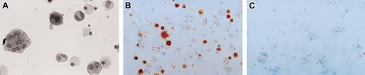 Figure 1. Micrographic pictures of megakaryocytic cells obtained from liquid culture of umbilical cord blood MNCs. Cells were cultured for 8 days in the presence of 10 ng/mL rhTPO and either control or ITP plasma. (A) Wright staining of a cytocentrifugation slide with cells from culture containing control plasma. Morphologically recognizable megakaryocytic cells at various stages of development were observed. Macrophage-like cells and small lymphocytes were the only major contaminating cells. Original magnification, × 400. (B) Immunohistochemistry staining (CD41, mAb 5B12) of cells from culture containing control plasma. Megakaryocytic cells are stained red. Original magnification, × 200. (C) Immunohistochemistry staining (CD41, mAb 5B12) of cells from culture containing group IIb/IIIa/Ib ITP plasma collected from an acute ITP patient at diagnosis. MNCs from the same umbilical cord blood was used for the cultures in panels B and C. None of the cells in this field stained positive for CD41. Original magnification, × 200.