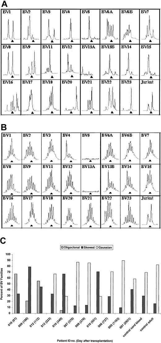 Figure 6. Immunoscope profiles of TCRBV repertoire. (A) Immunoscope profile for DIG012 on day 112 after transplantation. (B) Immunoscope profile for DIG012 at day 223 after transplantation. (C) Bar graph showing immunoscope TCRBV data for all surviving patients. The patient identification number and day after transplantation are given for each sample. Profiles from a control cord blood sample and a control adult sample are included. Each TCRBV family is graded as oligoclonal (eg, panel A, BV4), polyclonal skewed (eg, panel A, BV16), or polyclonal Gaussian (eg, panel B, BV6A).