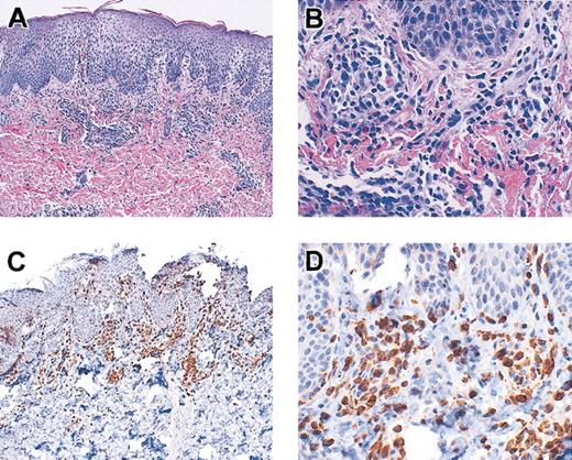 Figure 7. Skin biopsy from patient DIG009. Skin was stained with hematoxylin and eosin (original magnifications A, × 10; B, × 40) and was reacted with antibodies to CD3 (original magnifications C, × 10; D, × 40).