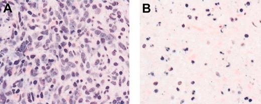Figure 2. Induction of apoptosis and necrosis in a patient with AML following SU5416 therapy. Bone marrow biopsy from a patient with AML shows sheets of leukemic cells before therapy (A) and generalized necrosis and apoptosis on day 29 of SU5416 therapy. Hematoxylin and eosin stain. Magnification × 400.