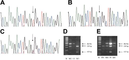 Figure 2. Detection of 598C>T mutation. Sequencing of exon 3 of the VHL gene detected a homozygous base change of C to T at nucleotide 598 in patients A1 to A3, B1 to B3, and C1 (A) when compared with the normal sequence (B). One patient, D1, was heterozygous for this base change (C). The position of the mutation is indicated by an arrow. The 598C>T mutation destroys the restriction site for BsrBI enzyme and the normal exon 3 PCR product is restricted into 2 fragments of 330 and 132 bp, but in the presence of the 598C>T mutation only a 462-bp fragment is obtained. Screening of family members of C1 indicated that his mother was heterozygous and his sibling was normal (D). The father of D1 is normal but his mother and son are heterozygous for the 598C>T (E). M indicates 100-bp DNA ladder; MC1, mother of patient C1; C1, patient C1; SC1, sibling of C1; FD1, father of patient D1; MD1, mother of patient D1; D1, patient D1; and SD1, son of D1.