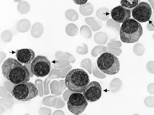Figure 1. Mature plasma cell morphology. Bone marrow myeloma cell infiltrate by mature malignant plasma cells including 45% of small mature plasma cells (arrows) in a patient with CD20+ MM and t(11,14). May-Grünwald-Giemsa staining; original magnification, × 1000.
