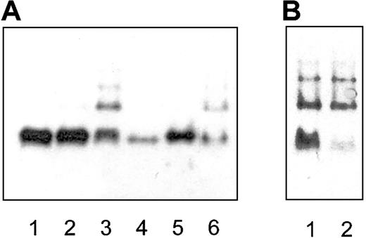 Figure 2. Native PAGE analysis followed by immunoblotting indicated that Phe229Leu AT spontaneously polymerized in the proband's plasma. (A) AT migration profile with a control plasma (lane 1), a heterozygous parent (lane 2), and the homozygous proband (lane 3) compared with purified human latent AT (lane 4), native AT (lane 5), and heat-polymerized AT (lane 6). (B) Analysis of the proband's plasma sampled after (lane 1) and during (lane 2) the sepsis-associated thromboembolic event; note the fall in the monomeric AT species during the acute phase.