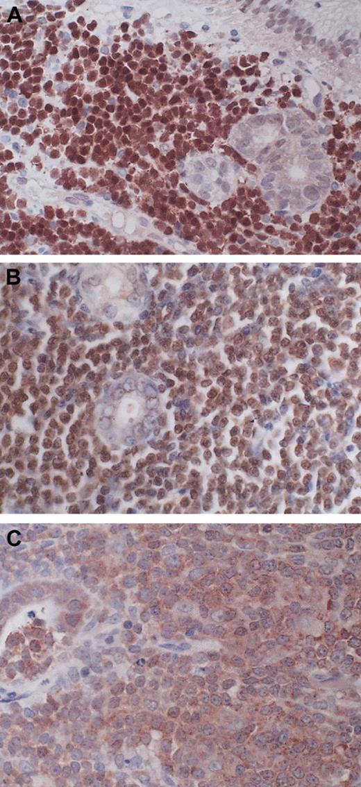 Figure 2. BCL10 expression pattern in MALT lymphoma. (A) A gastric MALT lymphoma shows strong BCL10 nuclear expression similar to that found in those with t(1;14)(p22;q32). (B) A t(11;18)(q21;q21)–positive gastric MALT lymphoma displays moderate BCL10 nuclear expression. (C) A gastric MALT lymphoma lacking t(11; 18)(q21;q21) shows cytoplasmic BCL10 expression. Original magnification, × 400 for all panels.