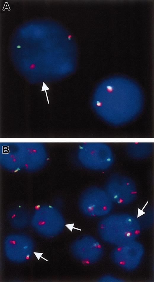 Figure 3. Break-apart double-color interphase FISH for the detection of breakpoints in the BCL10 locus. (A) Case with cytogenetically proven t(1;14)(p22; q32). The arrow points to a tumor cell in which the dissociation of the red and green signals indicates the presence of a chromosomal breakpoint in the BCL10 locus. The nucleus on the right displays 2 colocalized signals pointing to 2 intact copies of the BCL10 locus. (B) A gastric MALT lymphoma with strong BCL10 nuclear expression. Interphase nuclei from a paraffin section shows that several cells (arrows) display a split of the red and green signals, suggestive of t(1;14)(p22;q32) or variants.