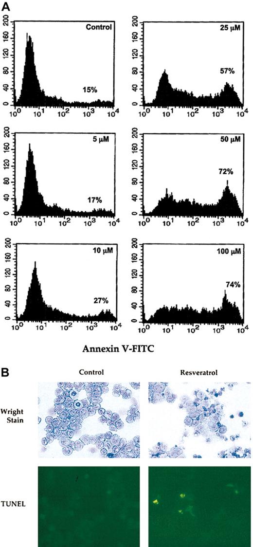 Figure 6. Resveratrol induces apoptosis in AML cells. (A) OCIM2 cells were incubated in the absence (control) or presence of 5, 10, 25, 50, or 100 μM resveratrol. The fraction of cells undergoing apoptotic cell death was detected by annexin V–FITC. The percentages presented in each frame depict the dose-dependent increase in the apoptotic cell fraction. (B) AML cells were incubated with or without 25 μM resveratrol. Cytospun cells were stained with Wright stain and TUNEL. After exposure to resveratrol (Wright stain in right upper corner) several cytospun cells show larger cytoplasm and other cells show pyknotic nuclei. Dividing cells were not found (as shown in the control culture in left upper corner) and numerous yellow-appearing apoptotic cells were detected (right lower corner). Original magnification, × 10.