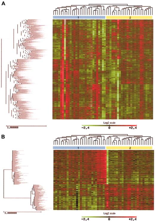 Figure 4. Identification of MF subgroups using hierarchic clustering methods. (A) Unsupervised clustering analysis of approximately 3400 genes in 53 MF cases revealed 2 main MF clusters. Cluster 2 tends to represent more patients with tumor stage disease and nuclear STAT3 expression, characteristics associated with aggressive disease. (B) Using a T statistic and an adjusted P value, genes significant in the differentiation of MF cluster 1 and MF cluster 2 were identified. After removal of ESTs and hypothetical genes, a total of 334 named genes were found. The expression pattern of these 334 genes is notably different between MF cluster 1 and cluster 2, as shown by unsupervised hierarchic clustering.