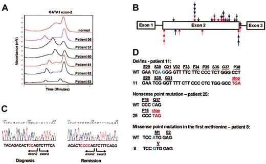Figure 1. Characterization of mutations in GATA1. (A) DHPLC analysis of PCR products of GATA1 exon 2 from DS patients with TMD. The patients' numbers correspond to the numbers in Table 2. Aberrant chromatogram is seen in all patients. (B) The scatter of mutations in exon 2. Arrows indicate the positions of the different mutations found in the patients screened. Arrows placed above the bar represent insertions/deletions; arrows below the bar represent point mutations. Red arrows indicate DS AMKL patients; blue arrows, DS patients with congenital TMD; green arrows, AMKL with acquired trisomy 21. (C) Sequencing of RT-PCR fragments of GATA1 amplified from bone marrow cells of patient 19 at diagnosis and remission. The mutation 392delCC is clearly seen in the sample taken at diagnosis, but the sample taken at remission is normal. (D) Different types of mutations in exon2 of GATA1.
