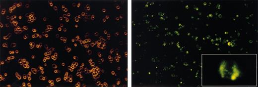 Figure 2. Labeling of human peripheral blood CD34+. Human primary CD34+ cells were seeded at a concentration of 500 000 cells in 200 μL stem cell media; 1 μL/mL fluorescent particle suspension was added to the well, and the cells were incubated at 37°C for 18 hours. The cells were collected, washed, and resuspended on a chamber slide for microscopy. The left panel shows light microscopy images of the cells, showing a uniform population of primitive hematopoietic progenitors with no evidence of toxicity and some cells undergoing active cell division; original magnification, × 100. The right panel is a fluorescent micrograph of the same field, showing that more than 90% of the cells fluoresce green, with relatively homogeneous intensity; original magnification, × 100. The inset is a higher-power view (× 1200) of a fluorescent cell in the midst of mitosis, with segregation of the label occurring to both daughter cells.