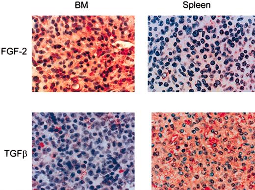 Figure 7. FGF-2 and the active from of TGFβ in HCL BM and spleen. Paraffin-embedded sections of HCL BM (n = 5) and spleen (n = 3) were stained immunohistochemically for FGF-2 or TGFβ by a triple-layer technique using ExtrAvidin-alkaline phosphatase as the final layer. Original magnification, × 40.