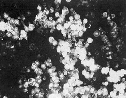 Figure 1. Direct intrafemoral injection procedure. One or both hind limbs of anesthetized mice were injected by DII with 30 μL PKH-26 dye at a concentration of 1 × 10-5 M. Bone marrow from injected femurs was harvested and analyzed for PKH-26 labeling by fluorescence microscopy (original magnification, × 400). The data shown are representative of 3 separate experiments.
