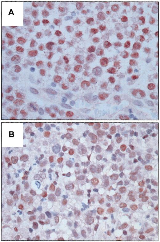 Figure 1. Expression of BCL-3 protein in systemic ALCL tumors. (A) An ALK-positive ALCL tumor with strong nuclear immunoreactivity in almost all tumor cells. (B) An ALK-negative ALCL tumor with relatively weaker nuclear immunoreactivity in many tumor cells. (Immunoperoxidase, DAB, hematoxylin counterstain, original magnification × 400.)