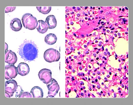 Peter Maslak, Memorial Sloan-Kettering Cancer Center