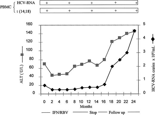Figure 3. Results in NR patient. Analysis of serum ALT values, serum HCV RNA titer, BL HCV RNA, and BL t(14;18) translocation in a representative NR patient who maintained positive BL HCVRNA and t(14;18)+, during follow-up.