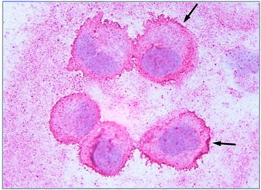 Figure 2. Immunostaining of Stx receptors. Immunohistochemical detection of the Stx receptor Gb3/CD77 on 5 single endothelial cells (HUVEC) immobilized onto glass slides by cytocentrifugation was performed with avidin biotin complex technique using a monoclonal rat antihuman CD77 primary antibody. Binding of the antibody is pictured as a red linear membrane stain (arrows, × 630).
