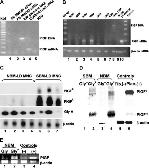 Figure 1. PlGF is produced by erythroid cells and is expressed in SCD bone marrow. (A) RNA was extracted from normal peripheral blood mononuclear cells (composed mainly of monocytes and lymphocytes, lanes 1 and 2) and an erythroid culture derived from normal bone marrow (lane 4) and subjected to RT-PCR analyses. PlGF primers used spanned 2 exons, giving a larger intron-containing band for genomic DNA (lane 3). (B) RT-PCR analysis on normal bone marrow cells (lanes 1 and 2), SCD bone marrow (SBM, lane 3), β-thalassemia major bone marrow (TBM, lane 4), and 2 normal umbilical cord blood mononuclear cells (UCB, lanes 5 and 6) using PlGF (top panel) and β-actin (bottom panel) primers. Lanes 7-10 are control lanes: H20 (lane 7) and the Molt T-cell line (lane 8) as negative controls, 293 cell genomic DNA as a DNA control (lane 9), and endothelial cells (lane 10) as a positive control. (C) RT-PCR analyses for PlGF, glycophorin A (an erythroid cell–specific gene), and β-actin followed by transfer and probing, showing the proportion of PlGF transcription in normal versus SCD light density mononuclear cells. The short (PlGFS) and long (PlGFL) exposure of the PlGF blot is shown to depict the small amount of PlGF mRNA in normal bone marrow and relatively high amount in sickle bone marrow. (D) Western blot analyses of glycophorin A+ (Gly+) and glycophorin A– (Gly–) light density mononuclear cells (LD-MNCs). Lanes 1 and 2 represent Gly+ and Gly– cells from SCD LD-MNCs (SBM), respectively; lanes 3 and 4 represent Gly+ and Gly– cells from normal bone marrow LD-MNCs (NBM), respectively; lanes 5 and 6 represent fibroblasts and placenta, as negative and positive controls, respectively. (E) RT-PCR analysis for PlGF on the NBM Gly+ and Gly– cells, shown in panel D (lanes 1 and 2). Lanes 3 and 4 represent controls.