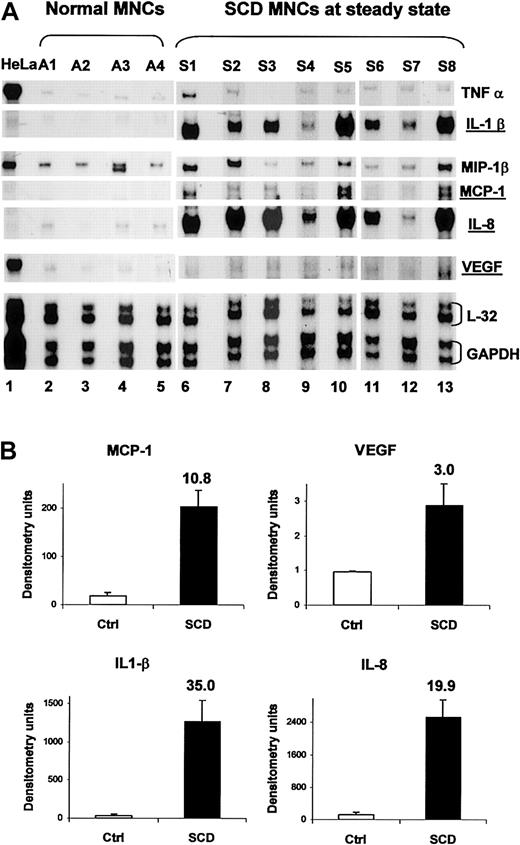 Figure 6. The cytokines and chemokines that are induced in normal MNCs with exogenous PlGF are also elevated in SCD MNCs at baseline. (A) RNase protection assay was performed using RNA from normal peripheral blood MNCs (A1-A4, lanes 2-5) and those derived from subjects with SCD at steady state (S1-S8, lanes 6-13). HeLa cell RNA was used as a control RNA. (B) Mean densitometry of MCP-1, VEGF, IL1-β, and IL-8 shown in panel A in normal controls (□) and in SCD patients (▪). Error bars represent SEM.