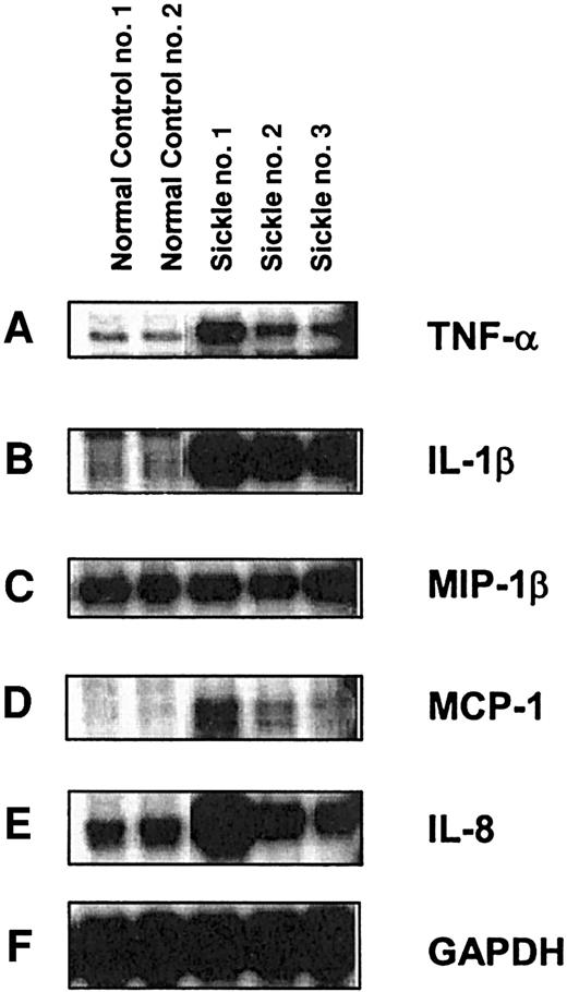 Figure 1. RPA analysis of mRNA expression of cytokines and chemokines in monocytes derived from healthy and SCD patients. Peripheral blood monocytes were isolated from the whole blood of SCD patients and healthy individuals. RNA was isolated using TriZOL reagent, and 2 μg RNA from each sample was analyzed by RNase protection assay using a Riboquant Multi-Probe RNase protection assay system (Pharmingen). RPA was performed with riboprobes for (A) TNF-α, (B) IL-1β, (C) MIP-1β, (D) MCP-1, (E) IL-8, and (F) GAPDH.