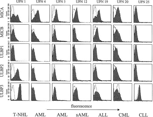 Figure 3. NKG2DL surface expression by leukemic cells. PBMCs from 6 patients with different hematopoietic malignancies were stained for NKG2DL expression with AMO1 (MICA), BMO1 (MICB), AUMO1 (ULBP1), BUMO2 (ULBP2), and CUMO2 (ULBP3), respectively, and investigated by FACS. Malignant cells were selected as described in “Patients, materials, and methods.” Shaded histograms represent expression of the indicated NKG2DL, and dotted lines show staining with the respective isotype control.