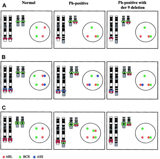 Figure 1. FISH systems for detection of the Ph translocation and derivative chromosome 9 deletions. In each case an ideogram and an interphase nucleus are shown for a normal cell, a cell carrying the Ph translocation alone (Ph positive), and a Ph-positive cell carrying a derivative chromosome 9 deletion (Ph positive with der9 deletion). (A) Early probe system. The ABL (red) and BCR (green) loci are labeled with different colored fluorochromes. No difference in the metaphase or interphase patterns is seen between patients who carry a deletion and those who do not. (B) Triple-probe system. In addition to the ABL and BCR loci a third probe containing the ASS gene is labeled in blue. With this system, the translocation again produces a fusion of the BCR and ABL probes on the Ph chromosome but also marks the derivative chromosome 9 with a single blue signal. This signal is missing in patients with deletions. (C) Dual-fusion probe system. The ABL and BCR loci are again labeled with different colored fluorochromes. However in these probe systems the probe size is larger and spans the translocation breakpoints. Both of these probes hybridize to the Ph chromosome and also to the derivative chromosome 9 creating 2 fusion signals in a Ph-positive patient who lacks a deletion but only one fusion signal in a Ph-positive patient with a derivative chromosome 9 deletion. In addition this system can differentiate between loss of chromosome 9 sequences only, chromosome 22 sequences only, or both from the derivative chromosome 9.