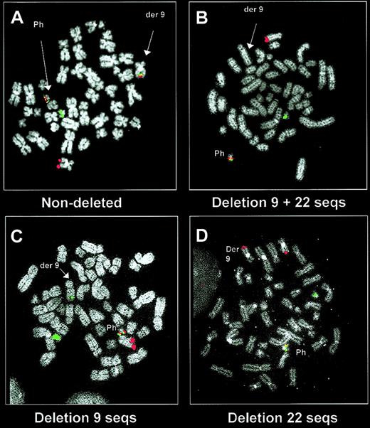 Figure 2. Demonstration of derivative chromosome 9 deletions by a dual-fusion probe system. Metaphase images are shown using a dual-fusion system (dual color, dual fusion probe system; Vysis) in a patient without a derivative chromosome 9 deletion (A) and in patients with a deletion (B-D). The ABL (red) and BCR (green) signals mark the normal 9 and 22 chromosomes, respectively, and the Ph chromosome is marked by a fusion signal. In patients without a deletion, the dual-color/dual-fusion system also labels the derivative chromosome 9 with a fusion signal (A). This fusion signal is missing from the derivative chromosome 9 in patients who carry a deletion of both chromosome 9 and 22 sequences (B). This probe system is also able to detect those patients in whom only chromosome 9 sequences (C) or chromosome 22 sequences (D) are deleted.