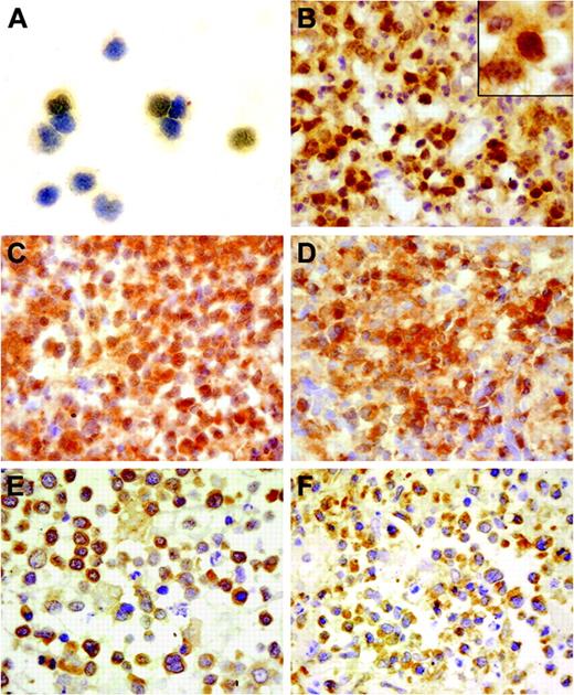 Figure 1. BCL10 protein expression in normal NK cells and NL and the NF-κB expression in NL. (A) A moderate immunoreactivity was detected only in the cytoplasm of NK cells. (B) The NL tumor cells from case 29 showed strong BCL10 expression in both the nucleus and cytoplasm. (C) Cytoplasmic BCL10 staining and aberrant nuclear staining of BCL10 on the tumor cells in case 28. (D) Nuclear localization of NF-κB was prominent in the same case in addition to the cytoplasmic staining, indicative of NF-κB activation in the tumor cells. (E) Cytoplasmic staining of BCL10 was present in the tumor cells of case 22. (F) Cytoplasmic localization of NF-κB is shown in the same case. Immunoperoxidase staining: original magnifications of panels A-F and inset in panel B are × 400 and × 1000, respectively.