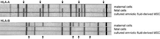 Figure 1. The Dynal Reli SSO (Dynal Biotech, Hamburg, Germany) reverse line blot strip assay was used for molecular typing of the HLA-A and HLA-B locus alleles of maternal cells, fetal cells, and culture-expanded amniotic fluid–derived MSCs from the same sample. The HLA-A and HLA-B type of the culture-expanded amniotic fluid–derived MSCs is identical to the fetal HLA-A and HLA-B type and mismatched with the maternal HLA-A and HLA-B type. Upward arrows indicate maternal specific HLA antigens, and downward arrows indicate fetal-specific HLA antigens.