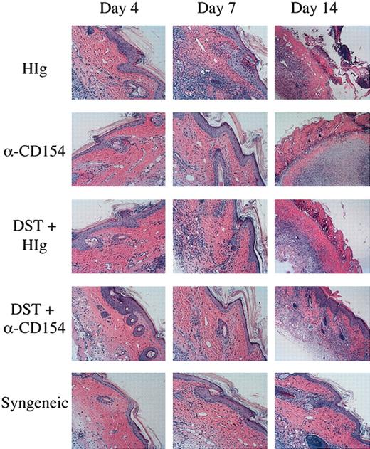 Figure 7. Reduced graft infiltration with DST and αCD154 treatment. TEa Tg T cells (1 × 106) were adoptively transferred into C57BL/6 RAG–/– recipients that received transplants of a CB6F1 skin graft and were treated with or without CB6F1 DST and/or αCD154 or H-Ig. Another group of mice received a syngeneic C57Bl/6 skin transplant as a negative control. Skin grafts were removed on days 4, 7, and 14, formalin fixed, and processed for H&E staining. Original magnification, × 100.