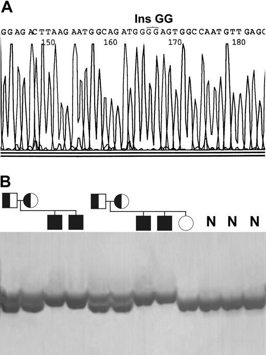 Figure 1. Identification of the homozygous 743-744insGG mutation in exon 9. (A) DNA sequence analysis indicating the site of the insertion. (B) Denaturing polyacrylamide gel electrophoresis showing the mutation in the family members and in the healthy individuals (N).