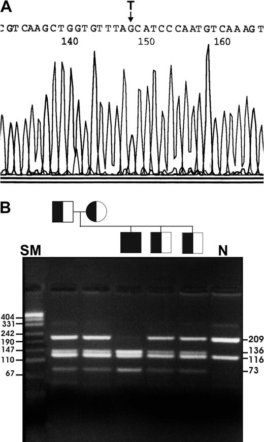 Figure 2. Identification of the homozygous 543T>G mutation in exon 8. (A) DNA sequence analysis showing the site of the substitution. (B) SfaNI digestion showing the mutation in the family members. N indicates normal control; SM, pUC19 DNA/MspI size marker. Numbers indicate bp.