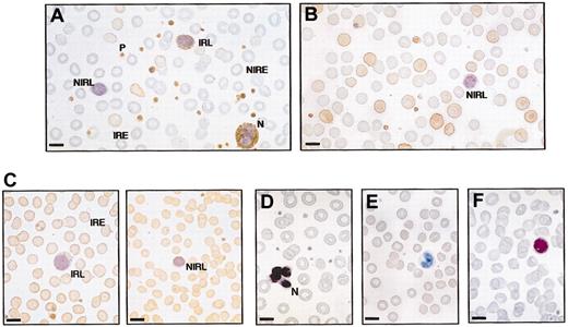 Figure 3. Immunocytochemistry of peripheral blood films from OHSt and healthy individuals. Blood films were stained with rabbit polyclonal antistomatin antibody (see “Patients, materials, and methods”) and counterstained with hematoxylin. Positive stomatin immunoreactivity is reflected by brown coloring. (A) Patient A-II-1. Some erythrocytes are stomatin immunoreactive (immunoreactive erythrocyte, IRE) but most are nonimmunoreactive (NIRE). All platelets (P) and the neutrophil (N) are immunoreactive. One lymphocyte is immunoreactive (immunoreactive lymphocyte, IRL), but the other is not (NIRL). (B) Patient B-II-1 shows a similar picture to patient A-II-1: mixed population of red cells; all platelets immunoreactive; and nonimmunoreactive lymphocyte. (C) Healthy control blood film. All erythrocytes are stomatin immunoreactive (IRE). All platelets are immunoreactive; there is a mixture of immunoreactive and nonimmunoreactive lymphocytes. (D-F) Negative controls, in which antistomatin antibody was omitted. (D) Patient A-II-1. Negative control and no first antibody. Neutrophil (N) and erythrocytes are all negative. (E) Patient B-II-1. Negative control omitting first antibody. (F) Normal blood film, negative control. Bar represents 10 μm.