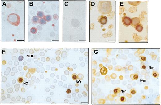 Figure 6. Immunocytochemistry of bone marrow and cord blood. (A-C) Patient A-II-1. Bone marrow, monoclonal antibody; and APAAP detection. (A) Pronormoblast. (B) Normoblasts. (C) Negative control, omitting primary antibody. (D-E) Normal bone marrow, showing normoblasts. Polyclonal antibody, ABC detection. (F-G) Patient A-III-1, cord blood. Polyclonal antibody, ABC detection. Most red cells are nonimmunoreactive. In panel F, 2 normoblasts (NO) are seen with stomatin immunoreactivity at the nucleus. One nonimmunoreactive lymphocyte (NIRL) is seen. In panel G, normoblasts extruding the nucleus can be seen (Nen). Counterstained with hematoxylin. Bar represents 10 μm.