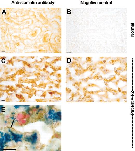 Figure 8. Liver sections stained with antistomatin antibody. Healthy control and OHSt patient. Detail of liver parenchyma showing the trabeculae of hepatocytes and sinusoids. Upper panels (A-B): normal liver; lower panels (C-E): patient A-I-2. (A) Stomatin immunoreactivity in normal liver is associated to the plasma membrane of the hepatocytes. Note the positive staining of red and white blood cells in the sinusoids. (B) Normal liver, negative control, and omitting antistomatin antibody. (C) Patient A-I-2: antistomatin antibody, nuclei counterstained with hematoxylin. As in the control, stomatin immunoreactivity is found associated to the plasma membrane of hepatocytes. Sinusoids are nearly free from red cells due to the fatal hemolytic crisis but show some immunopositive white blood cells. (D) Patient A-I-2: negative control, omitting antistomatin antibody, showing discrete granular brownish deposits of hemosiderin in the cytoplasm. Nuclei were counterstained with hematoxylin. (E) Stomatin immunostaining combined with Prussian blue reaction. Note the blue ferrocyanide-positive deposits in the cytoplasm and the brownish stomatin immunoreaction product that is accentuated at the plasma membrane (arrow). Bar represents 10 μm.
