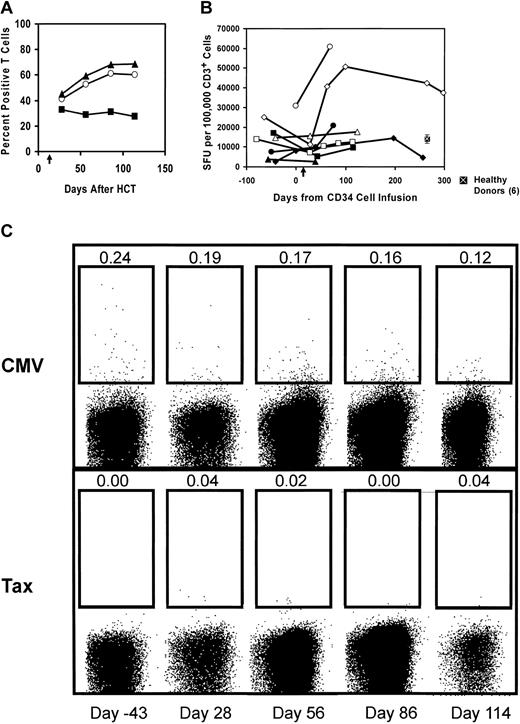Figure 6. Kinetics of T-cell functional recovery after HCT and adoptive T-cell infusion. (A) In vivo peripheral blood T cells regain inducible IFN-γ expression. PBMCs obtained following HCT and adoptive T-cell transfer were examined for intracellular IFN-γ expression by flow cytometry following stimulation by PMA and ionomycin as described in “Patients, materials, and methods.” The mean percent of cytokine-positive cells is shown (CD3+ T cells, ○; CD8+ T cells, ▴; and CD4+ T cells, ▪). Results shown are representative of 2 patients (UPN10 and UPN11) examined. (B) Recovery of T-cell IFN-γ secretion after HCT and T-cell infusion: NHL study patient mononuclear cells before and after HCT were stimulated with the phorbor ester and calcium ionophore as described in “Patients, materials, and methods.” Six healthy donors were also tested with the same stimuli, and the mean ± SEM is indicated. Plotted is the average of triplicate wells in spot-forming units per 1 × 105 CD3+ cells. UPN14, ♦; UPN15, ▪; UPN20, ▴; UPN23, □; UPN24, •; UPN25, ⋄; UPN26, ▵; UPN27, ○. Arrow along x-axis denotes day of T-cell infusion. (C) Frequency of CMV-specific CD8+ T cells in vivo via major histocompatibility complex (MHC) class I tetramer analysis. Tetramer analysis using the CMV pp65 HLA-A2–positive tetramer was controlled with the tetramer specific for the immunodominant HTLV-1 tax peptide. Time points shown are days from hematopoietic stem cell transplantation, which was 13 days prior to activated T-cell infusion. The percentage of CD8+ tetramer–positive T cells is shown above the population gated as positive for an HLA-A2–positive subject (UPN23).