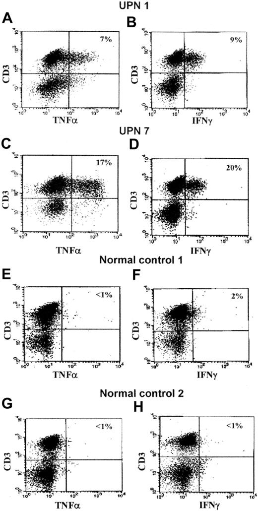 Figure 1. Examples of intracytoplasmic expression of TNF-α and IFN-γ in CD3+ BM MNCs from 2 representative FA patients (UPN 1 and 7) and 2 representative healthy control subjects. As shown in Table 2 and Figure 2, TNF-α and IFN-γ were also expressed in CD3– cells. In the top right corner of each scattergram the percentage of positive BM cells is represented. UPN 1: (A) CD3+/TNF-α+ cells, 7%; (B) CD3+/IFN-γ+ cells, 9%. UPN 7: (C) CD3+/TNF-α+ cells, 17%; (D) CD3+/IFN-γ+ cells, 20%. Healthy control 1: (E) CD3+/TNF-α+ cells, less than 1%; (F) CD3+/IFN-γ+ cells, 2%. Healthy control 2: (G) CD3+/TNF-α+ cells, less than 1%; (H) CD3+/IFN-γ+ cells, less than 1%.