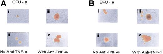 Figure 4. Effect of anti–TNF-α on erythroid-committed progenitor growth in FA patients. (A) CFU-Es grown in the absence of anti–TNF-α are shown (i,ii; medium alone). The size of CFU-Es cultured in the absence of anti–TNF-α but in the presence of purified Fc fragment of human IgG1 were not different (not shown). The addition of LD (1 μg/mL) anti–TNF-α (iii,iv) increased the size of CFU-Es grown from marrow MNCs of FA patients. A similar effect was seen with HD (10μg/mL) anti–TNF-α (not shown). (B) BFU-Es grown in the absence of anti–TNF-α are shown (i,ii; medium alone). The size of BFU-Es cultured in the absence of anti–TNF-α but in the presence of purified Fc fragment of human IgG1 were not different (not shown). Panel Bii shows a minor nonhemoglobinized component at the periphery. The addition of LD anti–TNF-α (iii,iv) increased the size of BFU-Es grown from BM MNCs of FA patients. A similar effect was seen with HD anti–TNF-α (not shown).