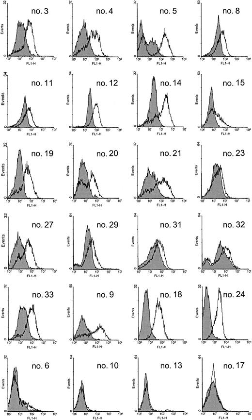Figure 2. IL-2 up-regulates CD38 expression in purified B-CLL cells. Cytofluorographic analysis of CD38 expression (gray histograms) in purified B cells from 24 CLL patients. B cells were purified from peripheral blood mononuclear cells by negative selection and stained with an anti-CD38 mAb followed by an FITC-conjugated GαMIg. The same cells were cultured for 3 days in the presence of 100 IU/mL IL-2 and re-evaluated for CD38 expression (open histograms). Analysis was carried out using a FACSort and scoring at least 5000 events/sample. The no. label refers to Table 1.