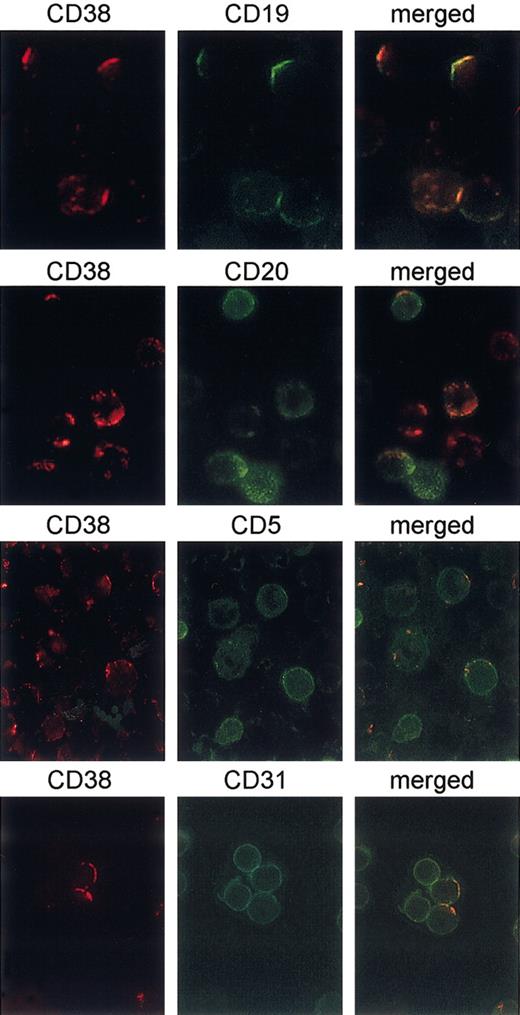 Figure 4. CD38 is laterally associated with CD19, but not with CD5, CD20, and CD31. B cells purified from 6 different CD38+ CLL patients were cultured for 3 days in the presence of 100 IU/mL IL-2 to increase CD38 expression. CD38 capping was induced on ligation with the IB4 mAb followed by binding with a TRITC-conjugated GαMIg for 30 minutes at 37°C (red). After blocking the experiment with the addition of cold PBS plus 0.1% NaN3, directly FITC-conjugated mAbs to CD19, CD5, CD20, and CD31 were added for 20 minutes at 4°C (green). The cells were then fixed and analyzed with an Olympus 1 × 70 microscope using the ANALYSIS software. The panels on the right show the merge of the 2 images. Original magnification × 60.