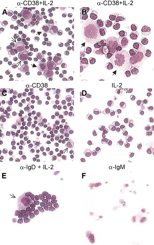Figure 8. CD38 ligation in the presence of IL-2 induces differentiation of B-CLL cells. B-CLL cells obtained from 10 different patients were exposed to the anti-CD38 mAb (C), IL-2 (D), or a combination of the two (A-B). A population of cells with an enlarged cytosol and a light perinuclear zone, with the characteristics of plasmablasts, was observed after culture with anti-CD38+ IL-2 (A, thin arrows). Several blasts were present in every sample tested (A-B, arrows). Ligation of IgD with a polyclonal antibody in the presence of IL-2 was included as control and induced the appearance of plasmablasts (E, arrow). Samples treated with an anti-IgM polyclonal antibody were primarily apoptotic or necrotic (F). Panels A, C, D-F: original magnification × 20. Panel B: original magnification × 40.